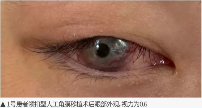 9-19患者眼表图-1.png