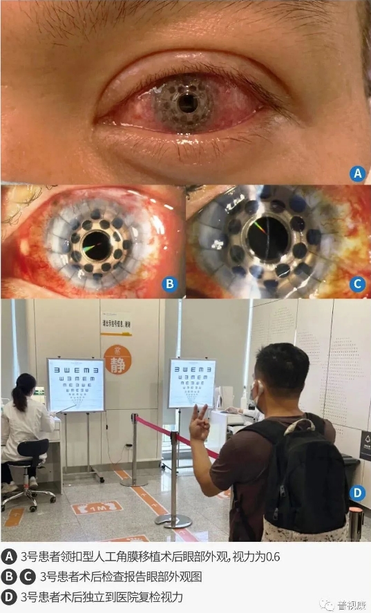 9-19患者眼表图-2.png
