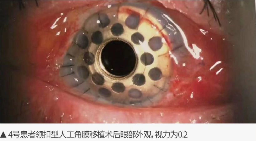 9-19患者眼表图-3.png