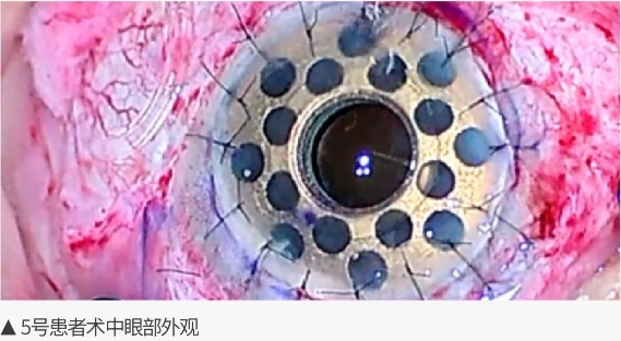 9-19患者眼表图-4.png
